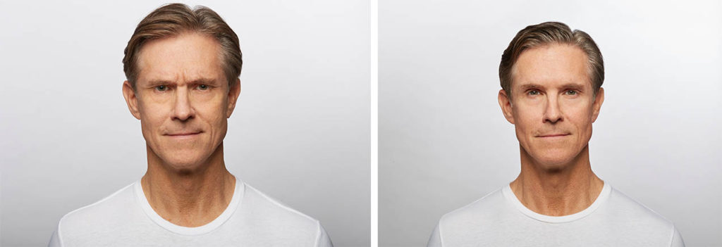 Before and After Dysport Botox