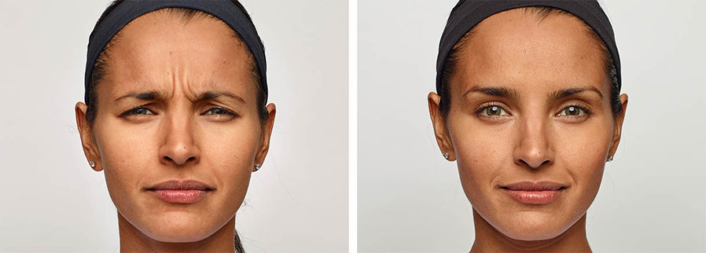 Before and After Dysport Botox