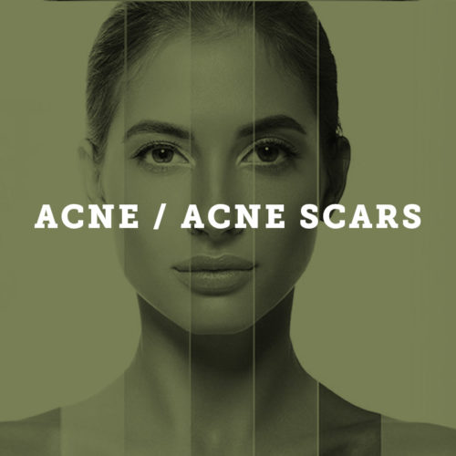 Acne/Acne Scars