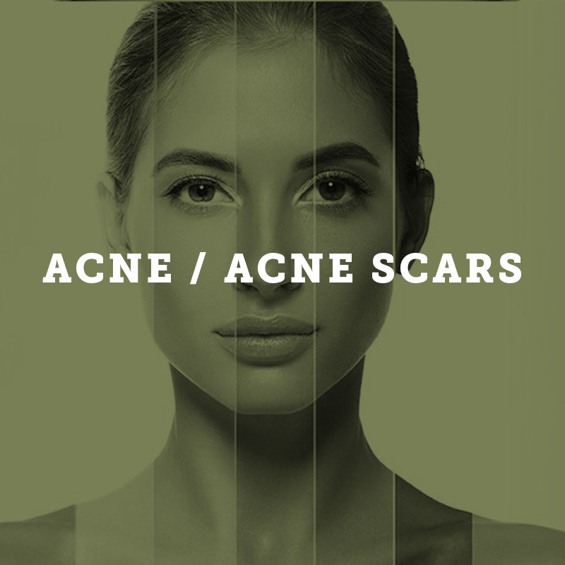acne Services