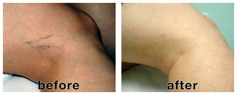 3 reasons to try SPLENDOR X laser hair removal technology 3 reasons to try SPLENDOR X laser hair removal technology