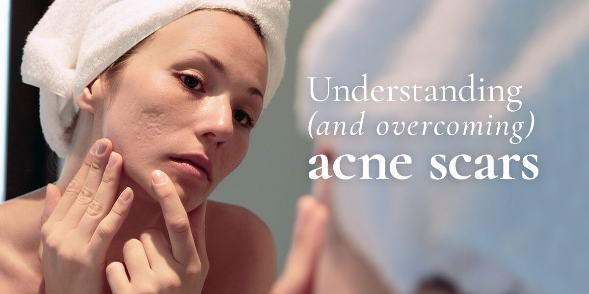 SOUTHGATE-SKIN-CENTER_JUL-BLOG-2 Understanding (and overcoming) acne scars - photo of a woman with acne scars looking at herself in a bathroom mirror