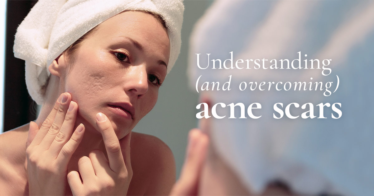 SOUTHGATE-SKIN-CENTER_JUL-BLOG-2 Understanding (and overcoming) acne scars - photo of a woman with acne scars looking at herself in a bathroom mirror