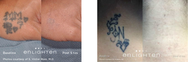 Before and After Laser Tattoo Removal