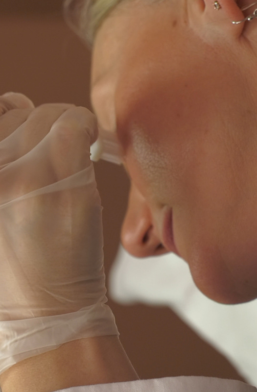 Chemical Peel Treatment