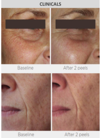 Before and After Glycolic Acid Peel