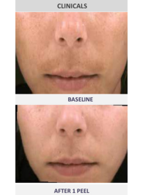 Before and After Jessners Acid Peel