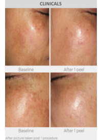 Before and After Pyruvic Acid Peel