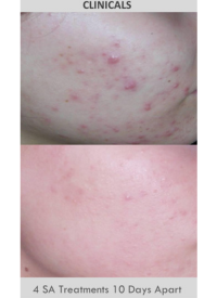 Before and After Salicylic Acid Peel